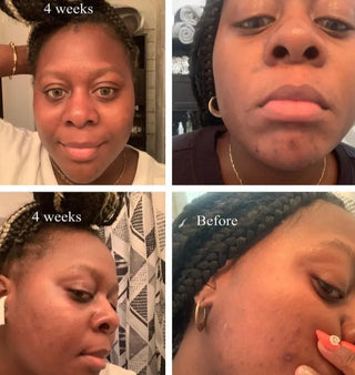 Acne Hydrating Moisturizer - Kandaka Safia