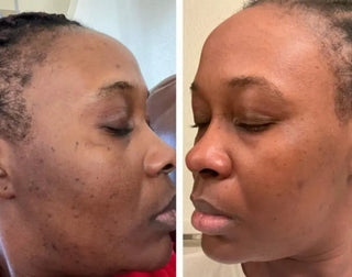 Acne Hydrating Moisturizer - Kandaka Safia