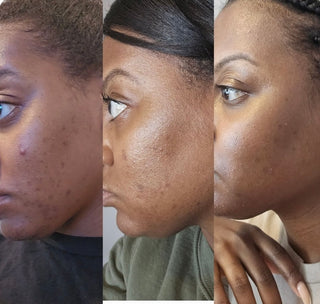 Acne Cleansing Soap Kandaka Safia