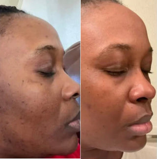 Acne Cleansing Soap Kandaka Safia