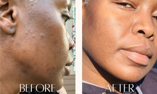 Acne Hydrating Moisturizer - Kandaka Safia