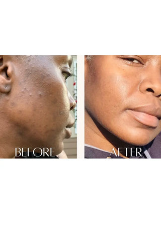 Acne Cleansing Soap - Kandaka Safia