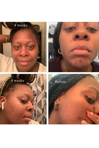 Acne Cleansing Soap - Kandaka Safia